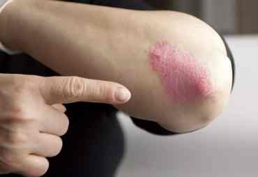 tratamiento psoriasis leon guanajuato