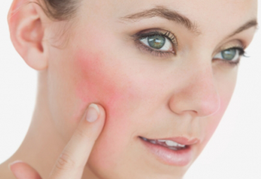 tratamiento rosacea leon guanajuato